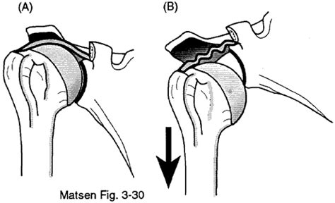 test to see if predisposed to tearing joint slipping|Atraumatic Shoulder Instability .